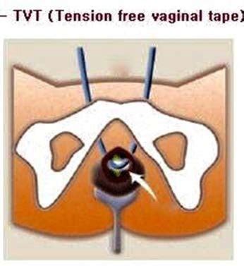 Tension Free Vaginal Tape Advanced Urogynecology Of Michigan PC