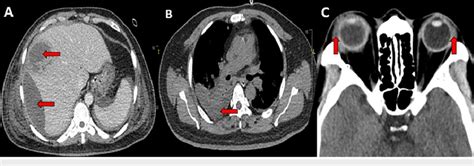 Contrast Enhanced Computed Tomography Cect Scans A Cect Liver