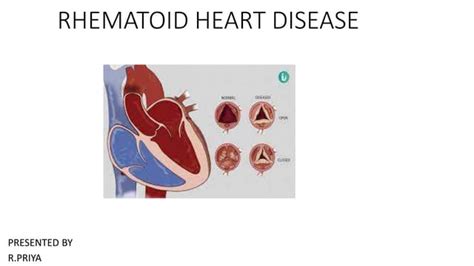 Rheumatic Heart Disease Causes Symptoms Diagnosis Ppt
