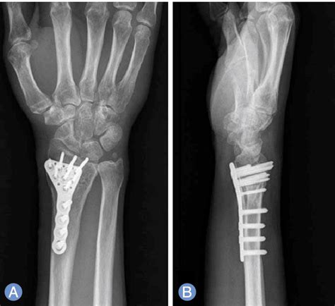 Distal Radial Fracture Tips Health 24 Hours