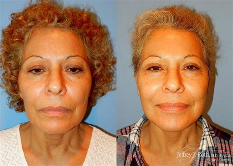 Facelift And Neck Lift Before And After Pictures Case 144 Las Vegas And