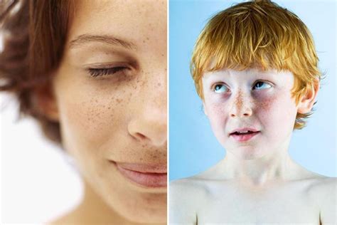 The Different Types Of Freckles Causes Prevention And Risks Of Sun