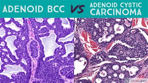 cutaneous adenoid cystic carcinoma vs adenoid basal cell carcinoma dermpath dermatology