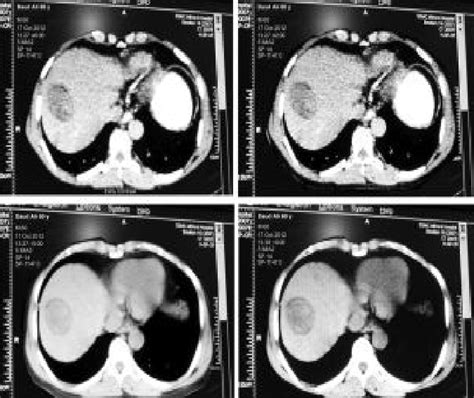 Triple Phase Axial Ct Scan Showing A Well Marginated Hcc In Right Lobe