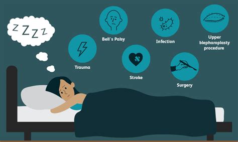 How To Sleep With Your Eyes Open Steps And Advice Spring 2023