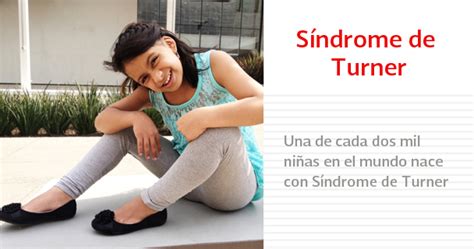 Sindrome De Turner Vivir Mejor