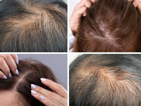 Hair Thinning Causes And Cures Cosmedica Dr Acar