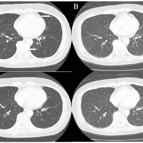 Chest Ct A Chest Ct Revealed Metastatic Lung Tumors In The Bilateral