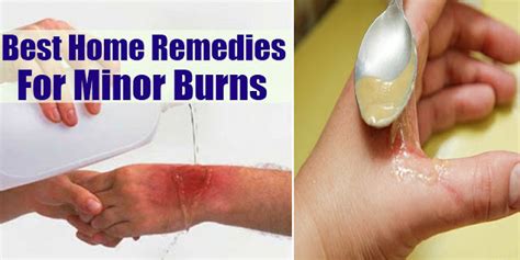 Simple Home Remedies For Minor Burns Style Hunt World