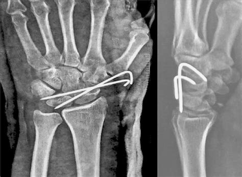 Frontal And Lateral Wrist Radiograph After Open Reduction And Metal Pin