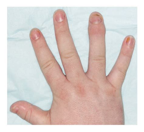 Swelling With Redness Of The Distal Interphalangeal Dip Joints Of The