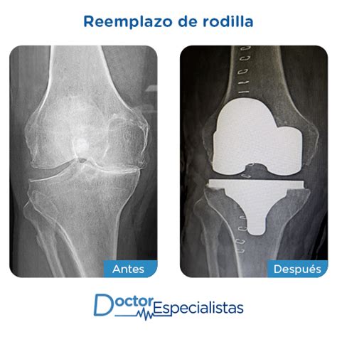 Mejores Ortopedistas Para Reemplazo De Rodilla Doctor Especialistas