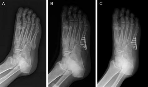 Locking Compression Plate Distal Ulna Hook Plate As Alternative Fixation For Fifth Metatarsal