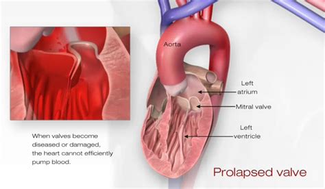 Problem Mitral Valve Prolapse American Heart Association
