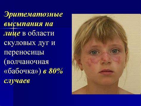 Диета системная красная волчанка Красная системная волчанка у детей Красная системная волчанка у детей Диета системная красная волчанка