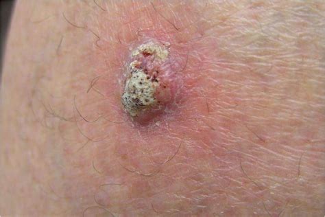 Squamous Cell Carcinoma Skin Cancer On Chest My XXX Hot Girl