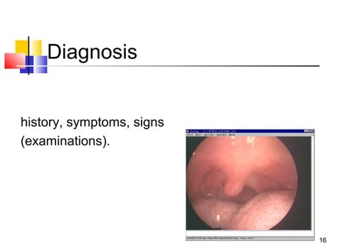 Acute Pharyngitis Ppt