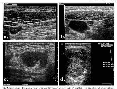 Pdf Ultrasonography Of Superficial Lymph Nodes Benign Vs Malignant