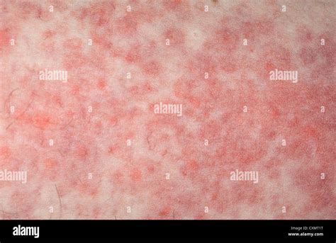 Allergic Maculo Papular Erythematous Skin Rash After Chemotherapy Stock