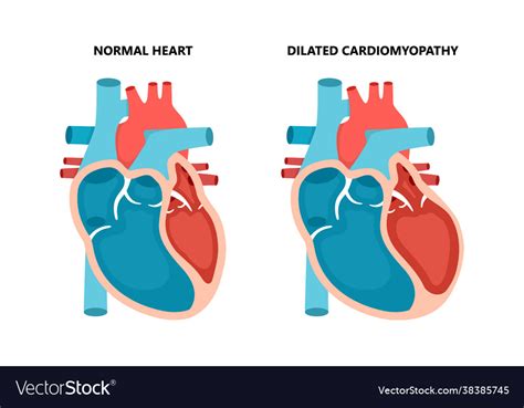 Dilated Cardiomyopathy With Cross Section View Vector Image