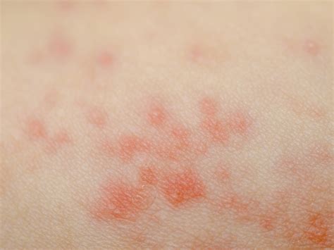 Eczema Symptoms And Causes Styles At Life