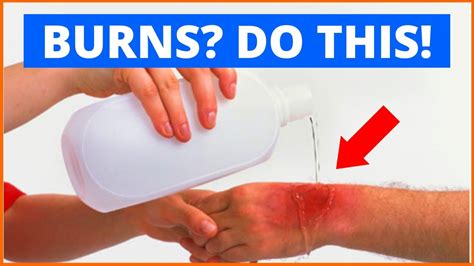 ⚠️ How To Treat Burns At Home First Aid For Burns And Scalds And
