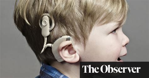 Bionic Ears Lets Hear It For Cochlear Implants Medical Research The Guardian