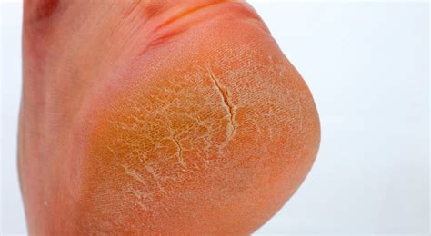 How To Heal Painful Cracked Heels Fast At Home Badly Cracked Heels