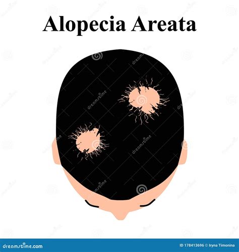 Alopecia Hair Baldness Of Hair On The Head Telogen Alopecia