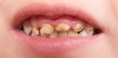 Karies — dieser artikel behandelt die karies der zähne, für andere bedeutungen von karies siehe karies (begriffsklärung). 20 Prozent der Kinder benötigen besondere Kariesprophylaxe ...