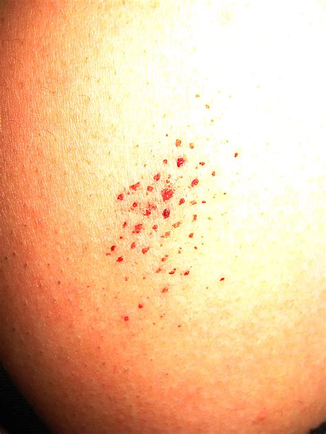 Blood Spot Strange Blood Spots Appeared On My Back After S Flickr