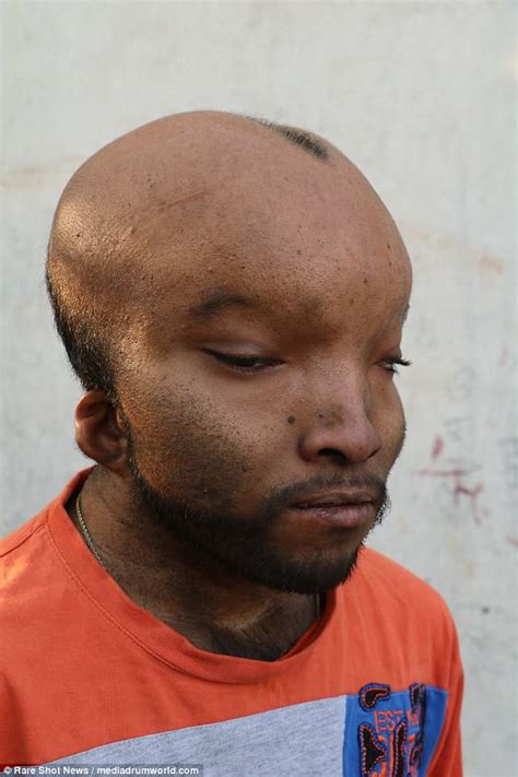 Indian Man Is Cruelly Branded Alien Due To Mysterious Condition