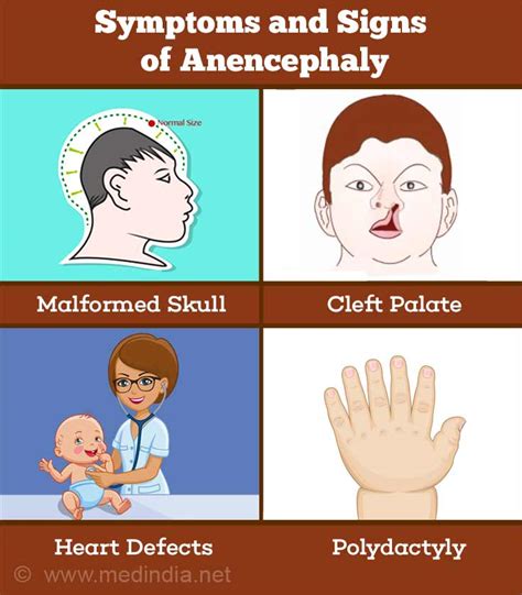 Anencephaly Causes Symptoms Diagnosis And Treatment