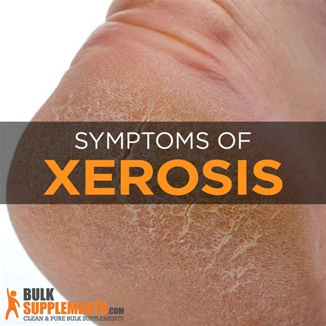Xerosis Dry Skin Symptoms Causes And Treatment