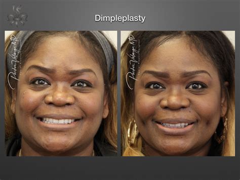 Dimpleplasty Case 3701 New Orleans Premier Center For Aesthetics And Plastic Surgery