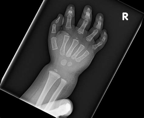 Ortho Dx Soft Tissue Swelling In The Hand Clinical Advisor