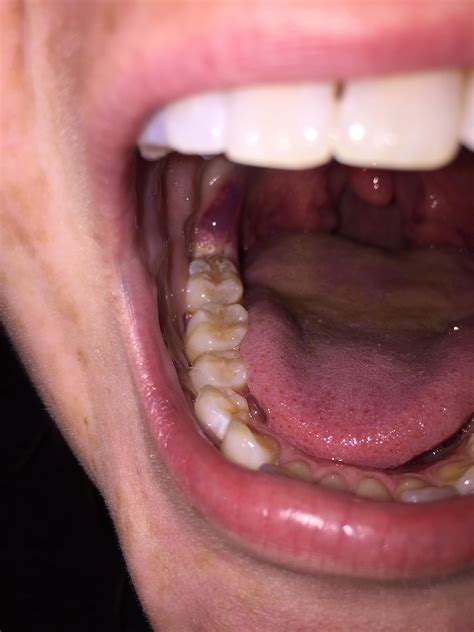 Super Painful Bubble After Dentist Cauterizedcut Excess Gum Flap Off