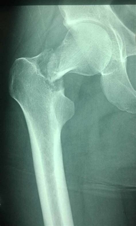 Femoral Neck Fracture X Ray Foliowery
