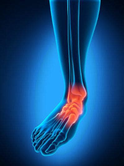 Ankle Sprain Or Fracture How To Tell The Difference Marilyn Boyuka
