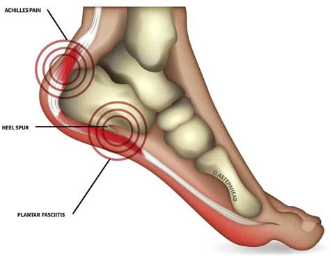 The pain started in the heel of my foot and was worse in the morning. it comes and goes … but now it is back and i am having a lot of pain in my heel. i cannot put pressure on my heel without it hurting. Extreme Heel Pain case study | A Step Ahead Foot + Ankle Care