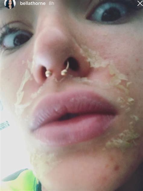 Pics Bella Thornes Chemical Peel See Photos Of Skin Falling Off Her