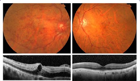 Fundus Photographs Upper And Optical Coherence Tomographic Oct