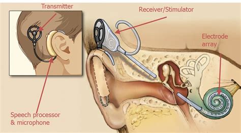 Hearing Impairment Try Cochlear Implants Captions