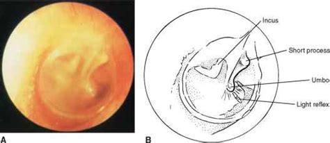 Tympanic Membrane Normal Appearance