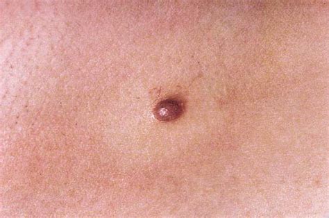 Nodular Melanoma Patients Perceptions Of Presenting Features And