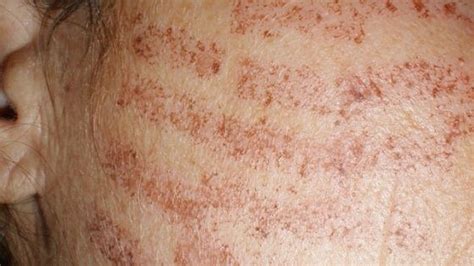 Laser Hair Removal Burns Causes Symptom And Treatment