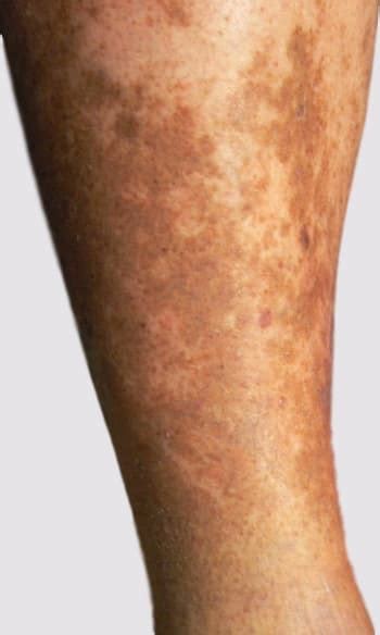 Varicose Veins Symptoms From Looks To Near Disabling