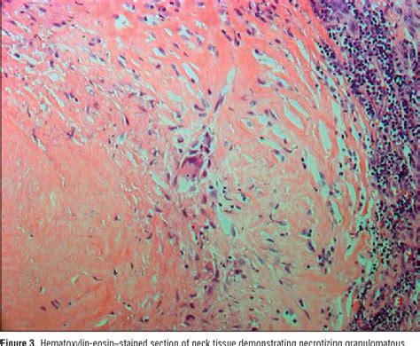 Figure 3 From A Case Series And Review Of Histoplasmosis Infection In