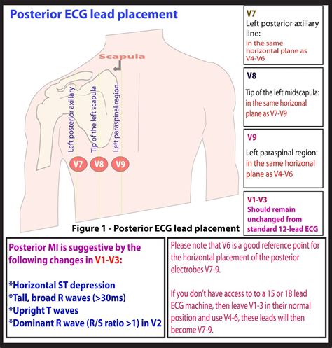 Posterior Ekg Lead Placement Ekg Placement Nursing Notes Emergency