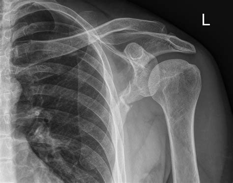 Oblique Shoulder For Scapular Fractures Wikiradiography
